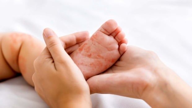 A baby's foot showing symptoms of measles is held by adult hands.