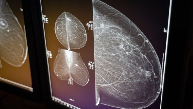  An x-ray image of a breast.