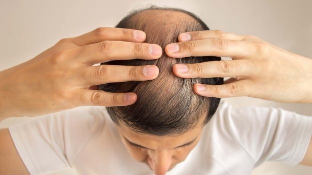 A person holds their hands to the top of their head, which shows some hair loss.