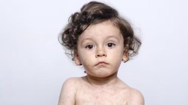 A child with measles poses for a stock photo.