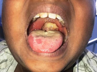 FCTA announces Diphtheria outbreak in Abuja