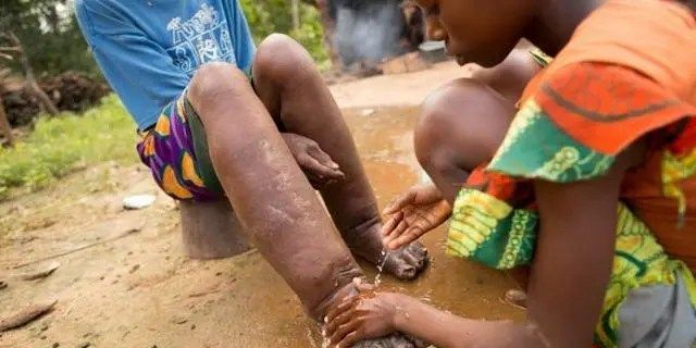 A victim of a Neglected Tropical Disease (NTD). [PHOTO CREDIT: Health Digest]