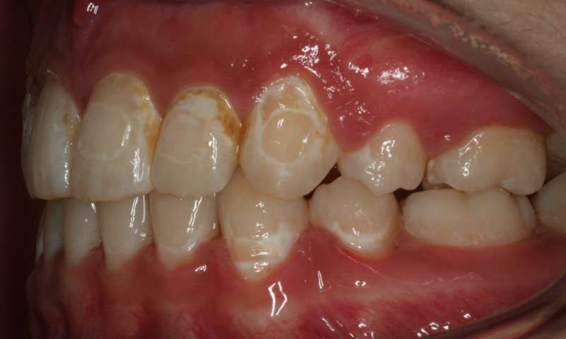 Decayed teeth